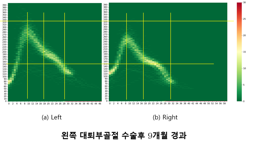 홈 트레드밀과 무릎 통증: 관절 부담을 줄이는 데이터 기반 보행 분석의 중요성